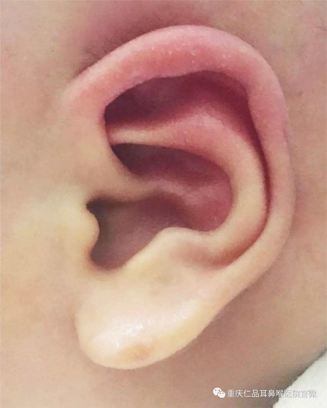 耳朵矫正后