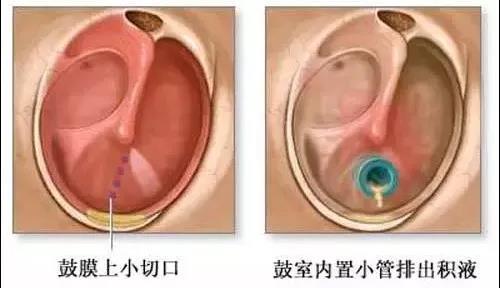 鼓膜