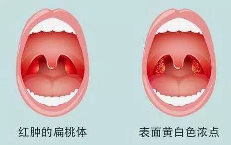 扁桃体炎