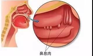 鼻息肉