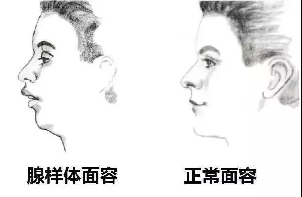 腺样体面容