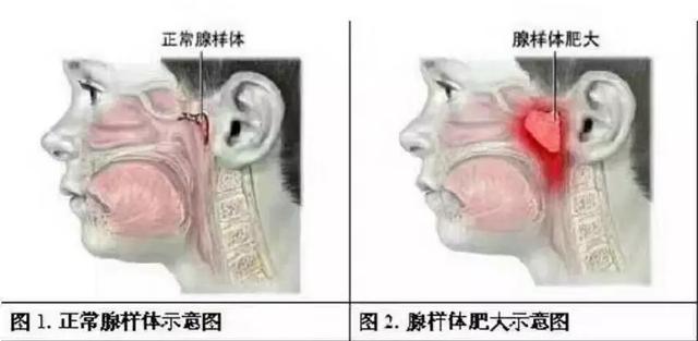 腺样体肥大