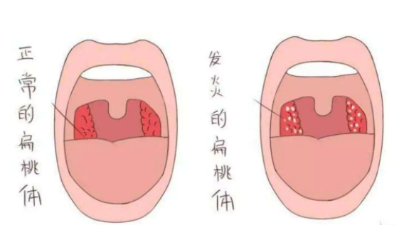 鼻甲肥大