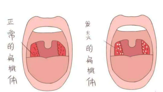 扁桃体炎的症状有哪些