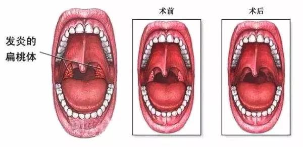 扁桃体炎的常见症状类型
