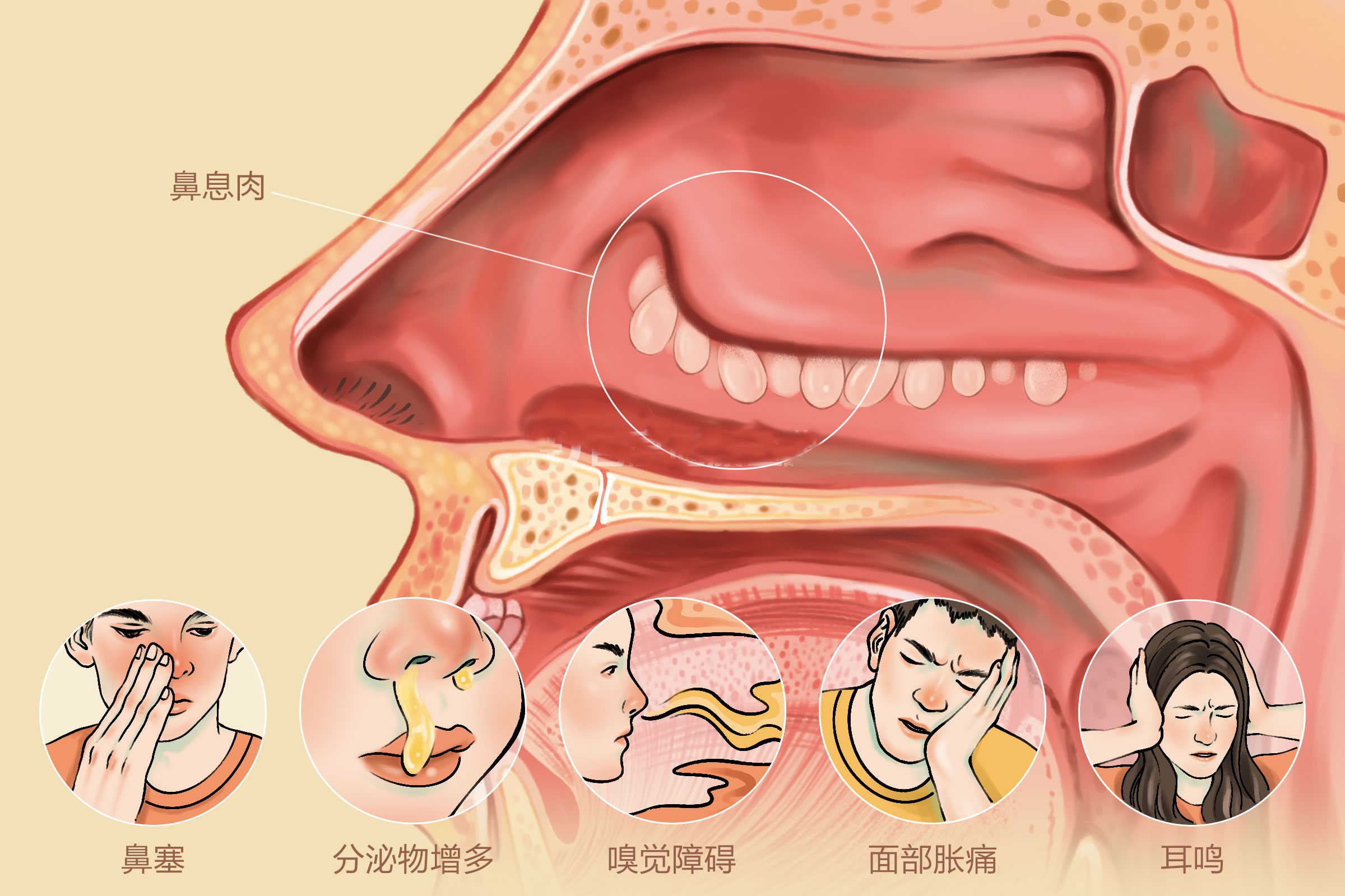 鼻息肉的症状