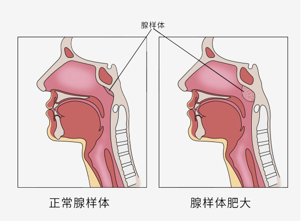 腺样体肥大