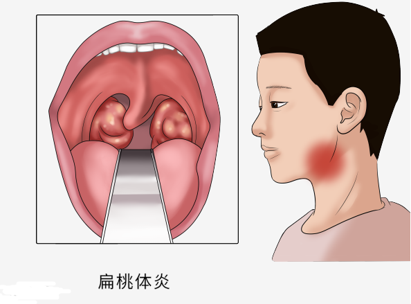 扁桃体炎