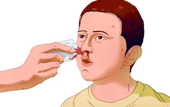 鼻出血