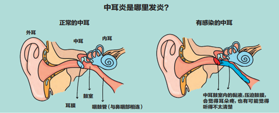 中耳炎