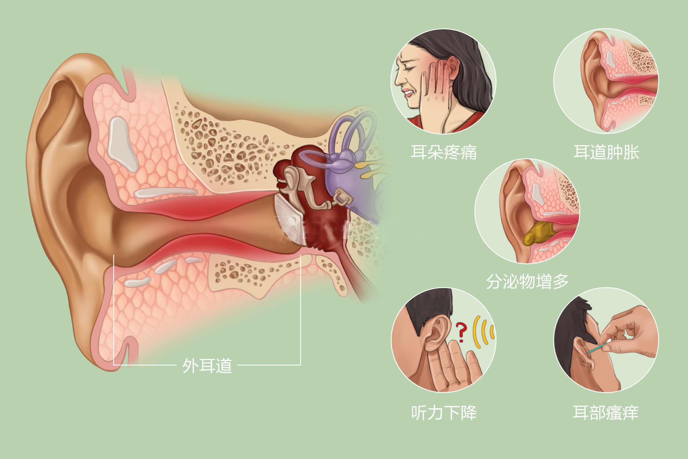 外耳道炎的典型症状