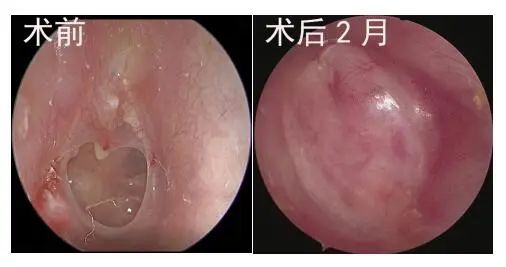 鼓膜穿孔的治疗